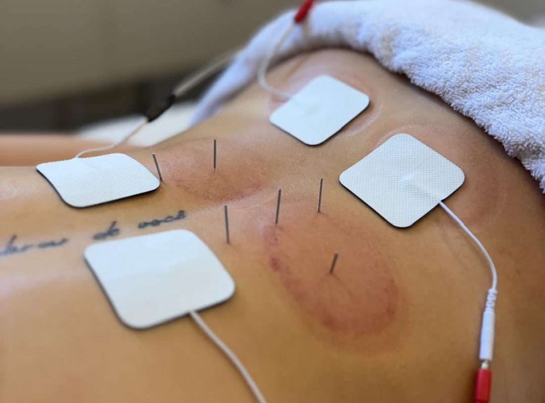 eletroterapia-qr7ZkDt9